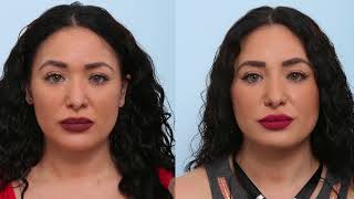 Dr. Vitenas Discusses the Results of a Non-Surgical Rhinoplasty