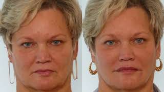 Learn How Dermal Fillers Can be Used For a Liquid Facelift