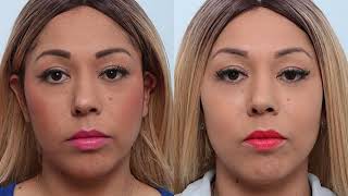 What is the Buccal Fat Pad Removal Procedure by Board Certifed Plastic Surgeon Dr. Paul Vitenas