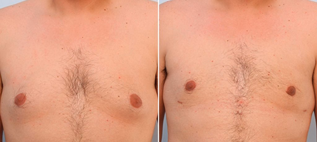 Breast Reduction before & after photos frontal view