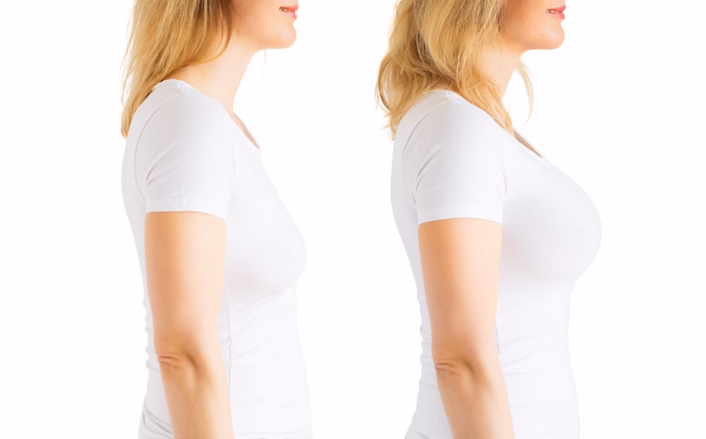 Breast augmentation is a surgical procedure that is performed to add volume to the breasts.
