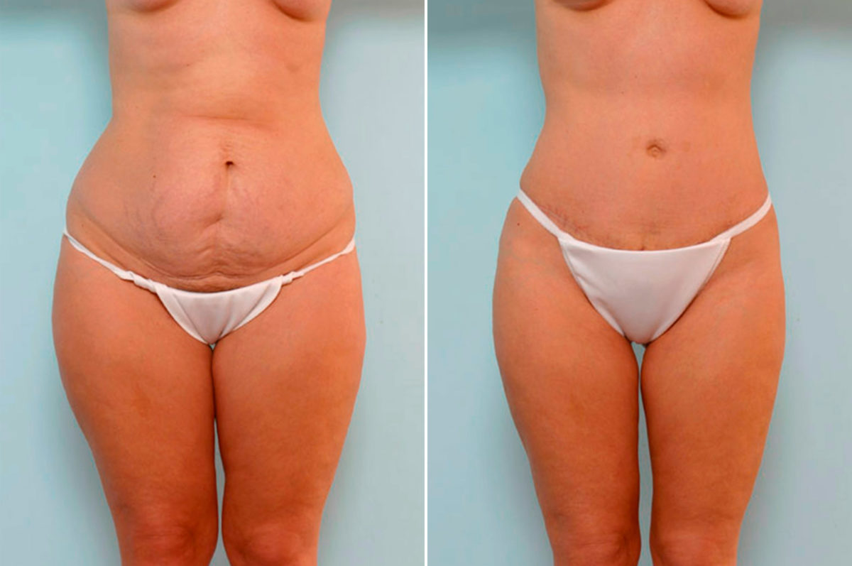 Secrets to Maintaining Your Tummy Tuck Results