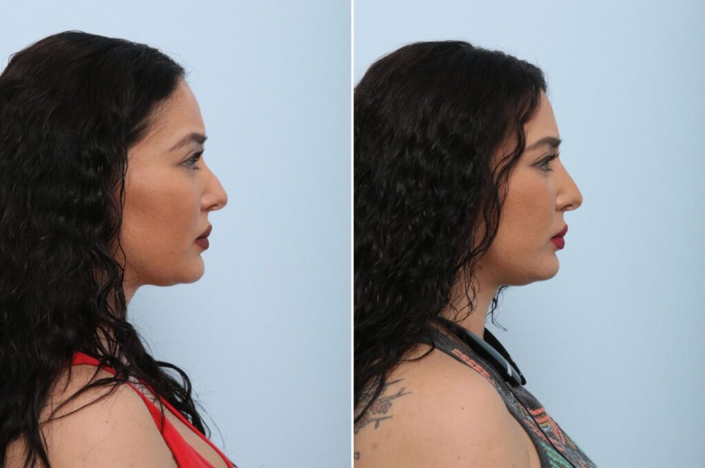 This patient came to Dr. Vitenas, wanting to address an issue with her nose, which had been bothering her for some time. The nose looked unbalanced, the mid-section of the nose was too full for the top section. Her nasal tip was also crooked. Dr. Vitenas added Restylane to the nose to straighten the tip and improve the hump on the dorsum of the nose, thereby creating beautiful dorsal aesthetic lines.