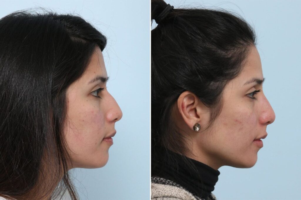 This patient wanted to look her best for her wedding! She came to Dr. Vitenas, interested in a non-invasive rhinoplasty. She had always been self-conscious about her nose and was able to have this taken from her in a few minutes by this procedure. Dr. Vitenas added filler to her nose, making it look thinner as well as softening the bump on her nasal bridge.