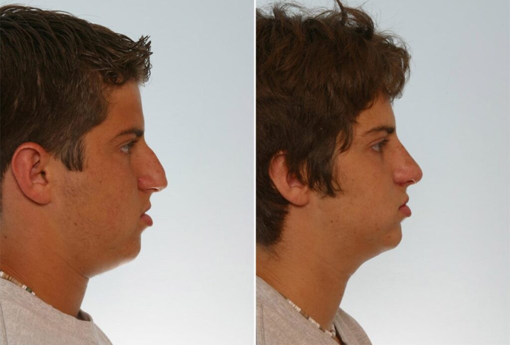 The Before/After photos show a 15 year old boy from Houston, who was struggling with an oversized nose. To correct the large bridge and resize the nose, Dr. Vitenas performed a Rhinoplasty. When the patient returned to school, his features were proportionate and he looked like a new young man.