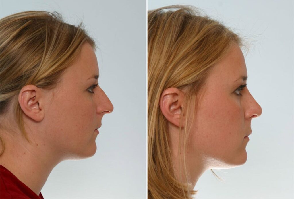 Almost ready to graduate from college, this 20 year old Nacogdoches patient wanted to enhance her appearance. Dr. Vitenas performed a Rhinoplasty, giving shape and a more appropriate size to her nose. After the procedure, she felt beautiful. The patient was confidently ready to start her career.