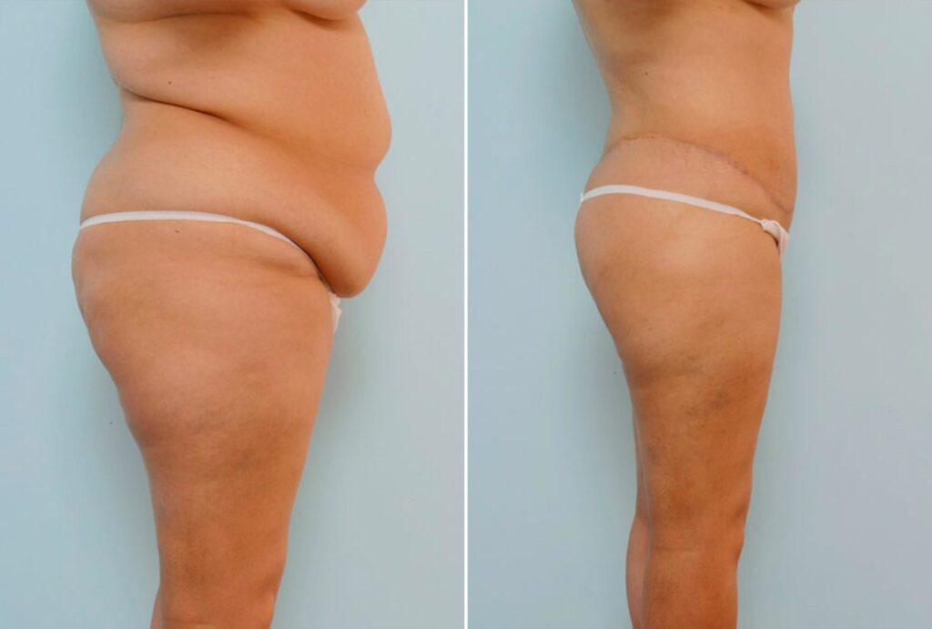 At 30, this Odessa patient had been thinking of a Body Lift for several years. Dr. Vitenas was pleased to perform her procedure; he removed 3.8 pounds of tissue from her lower back and 4.5 pounds of tissue from her front abdomen. To further enhance her body shape, Liposuction of the lower back, hips, thighs, and knees was added to the procedure. Her resulting trim figure was more than she had hoped for.