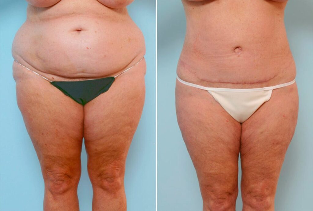 After an extreme weight loss of over 100 pounds, this Katy patient had large amounts of lax, drooping skin. Unable to address the excess tissue with diet or exercise, she chose a Body Lift. Dr. Vitenas removed 6.75 pounds of tissue from her back and 4.5 pounds of tissue from her back. Her figure was transformed to a tighter, slimmer shape.