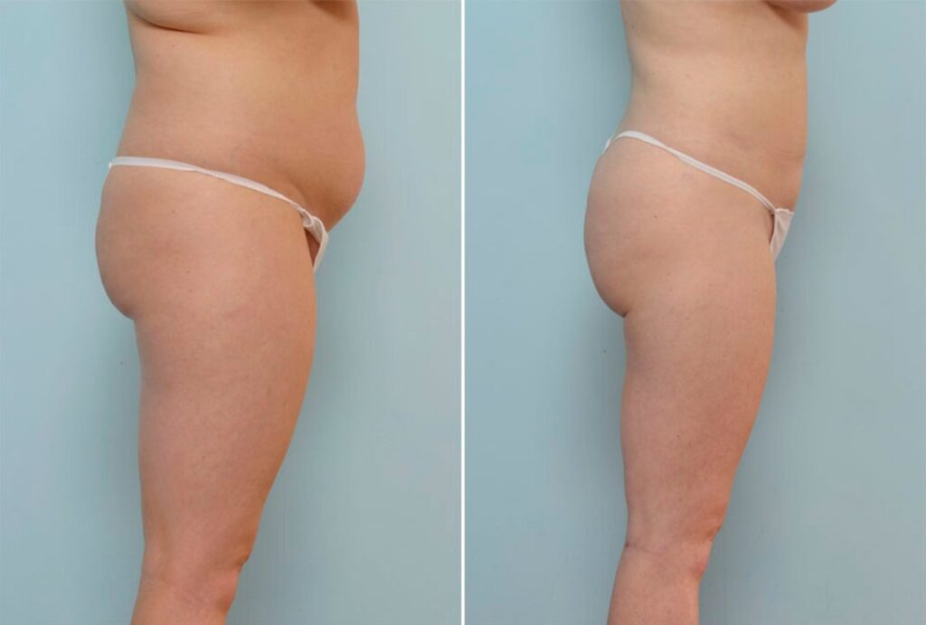 The time had come, for this 30 year old from Katy to do something about her diminishing figure. Dr. Vitenas performed a Liposuction of the abdomen, back, hips, thighs, knees, and arms; removing 13,025cc of fatty deposits. Her results were astonishing; she could not have been happier.