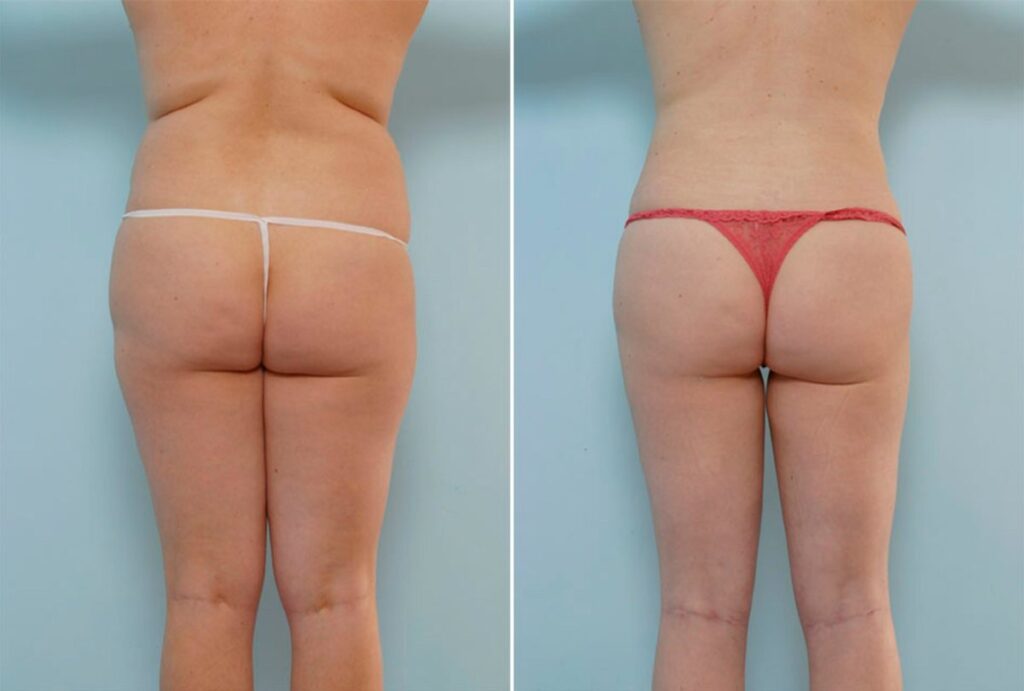 The time had come, for this 30 year old from Katy to do something about her diminishing figure. Dr. Vitenas performed a Liposuction of the abdomen, back, hips, thighs, knees, and arms; removing 13,025cc of fatty deposits. Her results were astonishing; she could not have been happier.