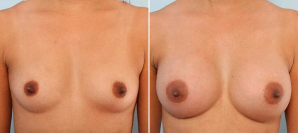 These Before/After photos show a breast augmentation with 330cc, Style 15, Natrelle Gel implants in both breasts. The 25 year old patient from Sealy went from a B cup to a Full C cup.