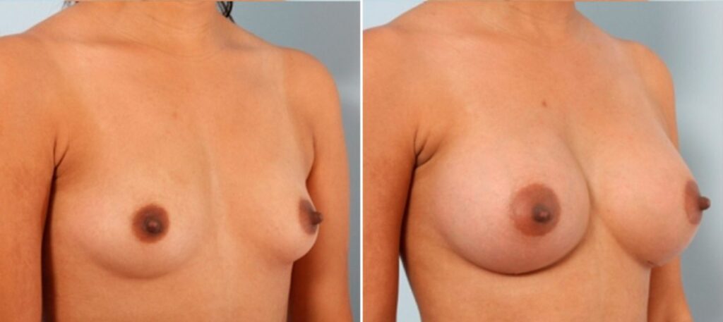 These Before/After photos show a breast augmentation with 330cc, Style 15, Natrelle Gel implants in both breasts. The 25 year old patient from Sealy went from a B cup to a Full C cup.