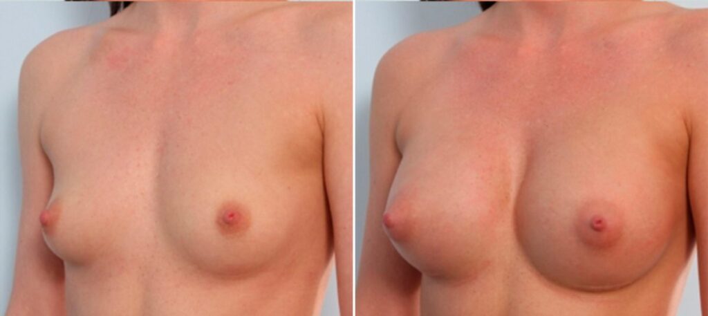 Coming to Vitenas Cosmetic Surgery from Alvin, this 30 year old patient wanted breast augmentation to increase the size of her A cup breasts. Natrelle Gel implants were used, 339cc on the right and 371 on the left, correcting asymmetry and bringing the patient up to a C cup size.