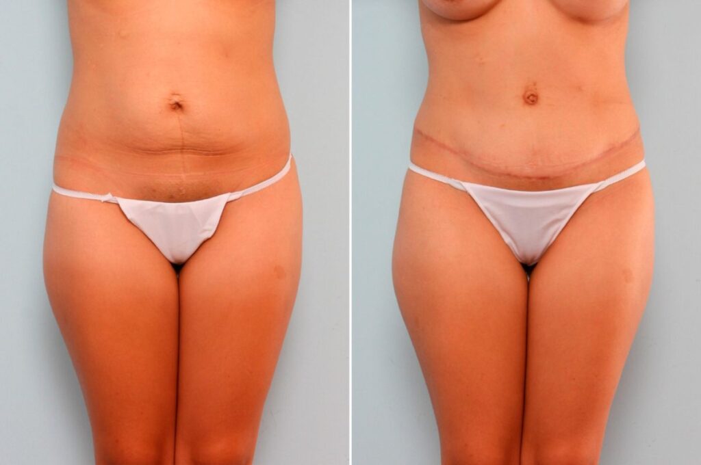 This patient came to Dr. Vitenas, wanting a transformation that could restore her confidence. She needed volume for her breasts and desired to get rid of excess skin on her tummy. Dr. Vitenas performed a Breast Augmentation that improved her lack of volume and a Tummy tuck that gave her a tight youthful figure. Dr. Vitenas’ Mommy Makeover successfully restored a harmonious balance to her figure.