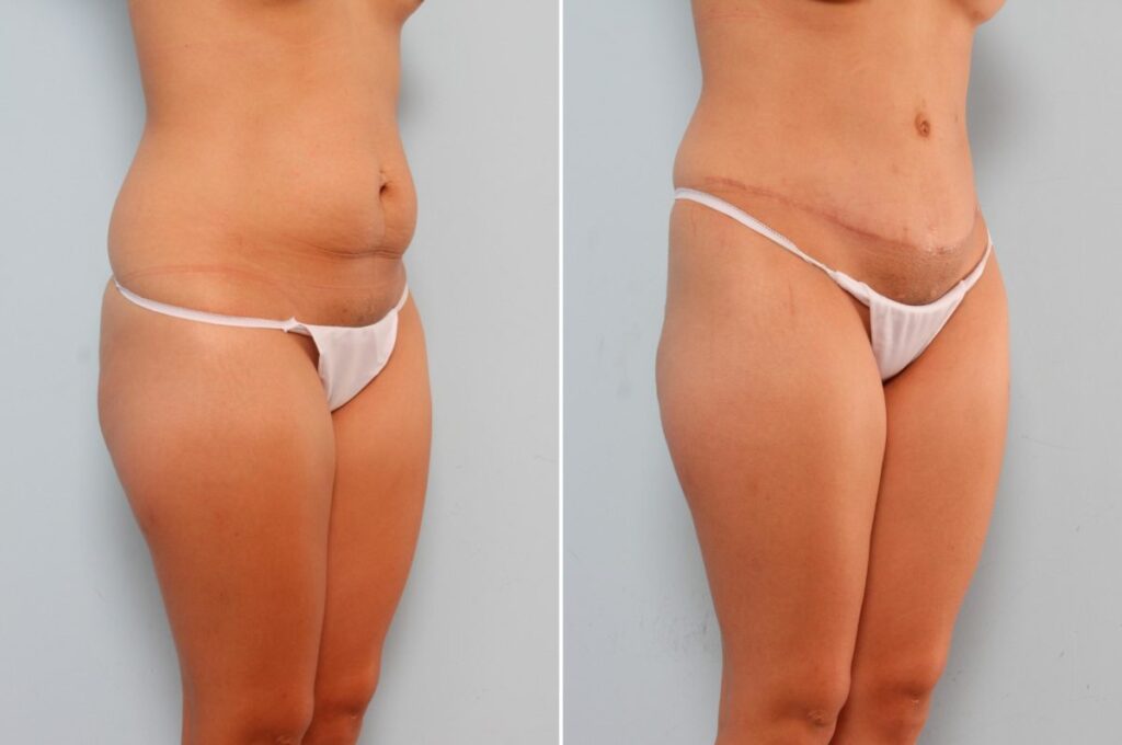 This patient came to Dr. Vitenas, wanting a transformation that could restore her confidence. She needed volume for her breasts and desired to get rid of excess skin on her tummy. Dr. Vitenas performed a Breast Augmentation that improved her lack of volume and a Tummy tuck that gave her a tight youthful figure. Dr. Vitenas’ Mommy Makeover successfully restored a harmonious balance to her figure.