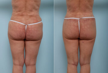 Back Lift before and after photos in Houston, TX, Patient 43077