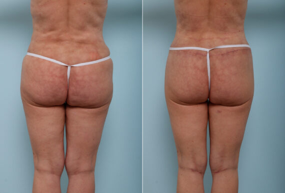 Back Lift before and after photos in Houston, TX, Patient 43077