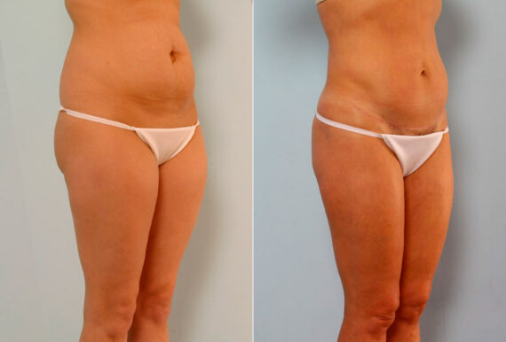 Tummy Tuck/Abdominoplasty before and after photos in Houston, TX, Patient 24219