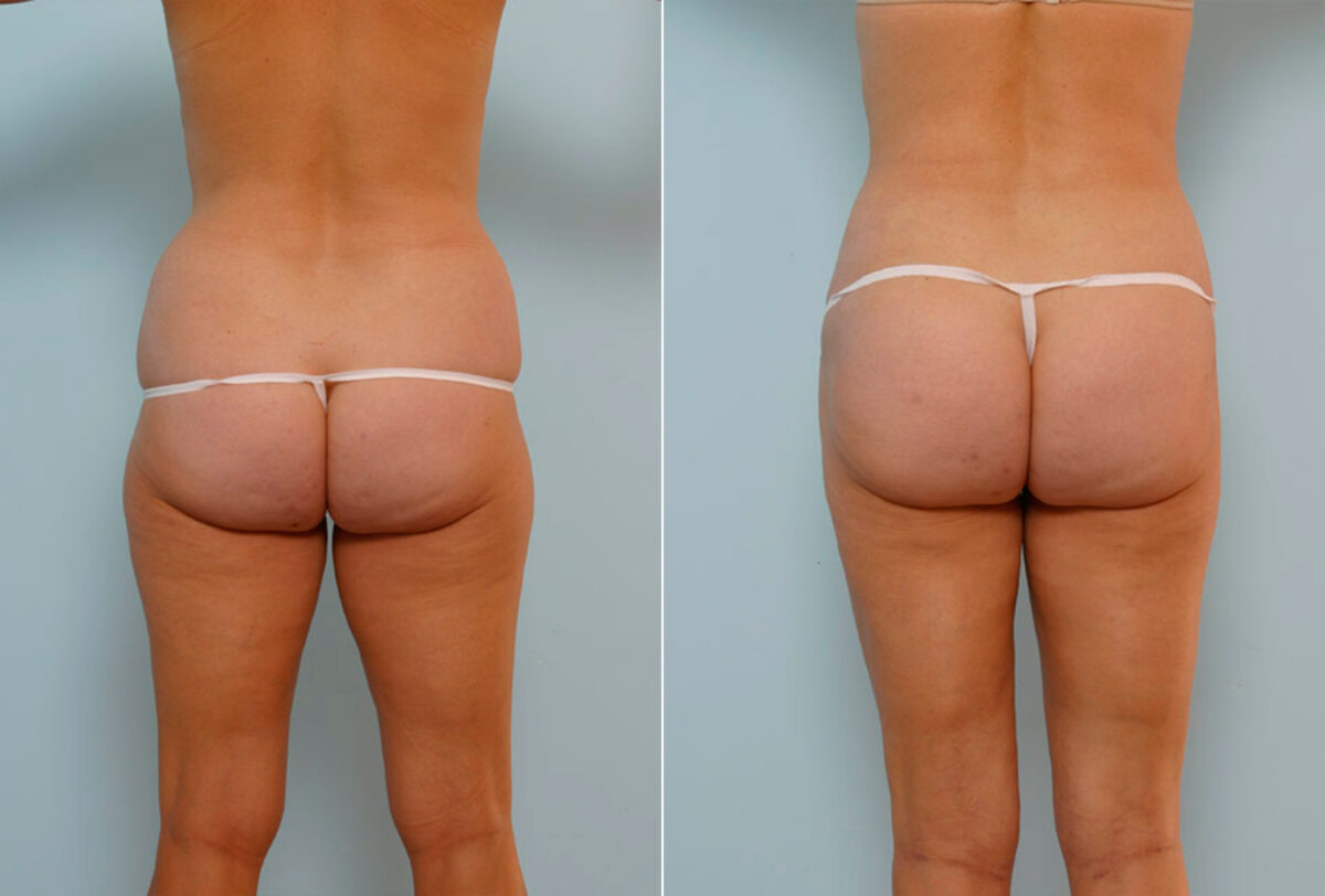 Abdominoplasty before and after photos in Houston, TX, Patient 24419