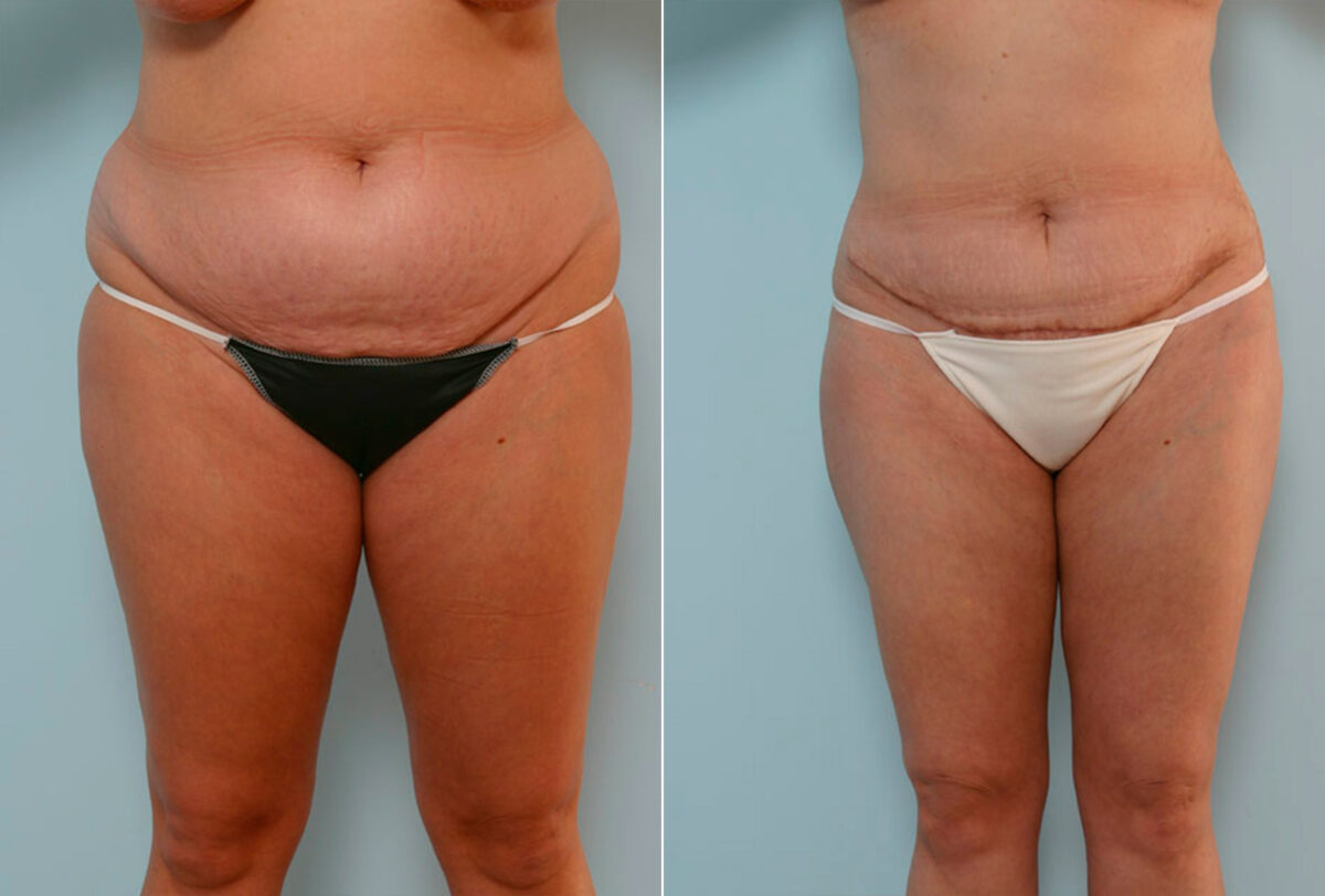 Tummy Tuck/Abdominoplasty before and after photos in Houston, TX, Patient 24428