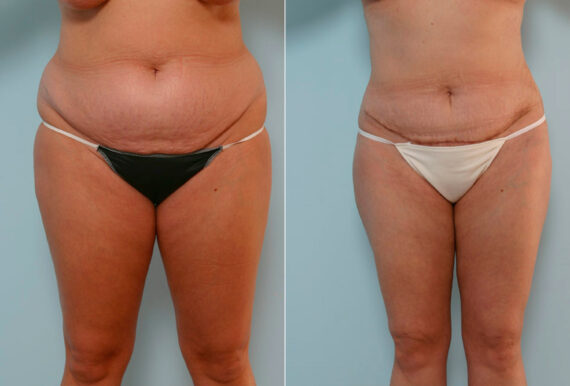 Abdominoplasty before and after photos in Houston, TX, Patient 24428