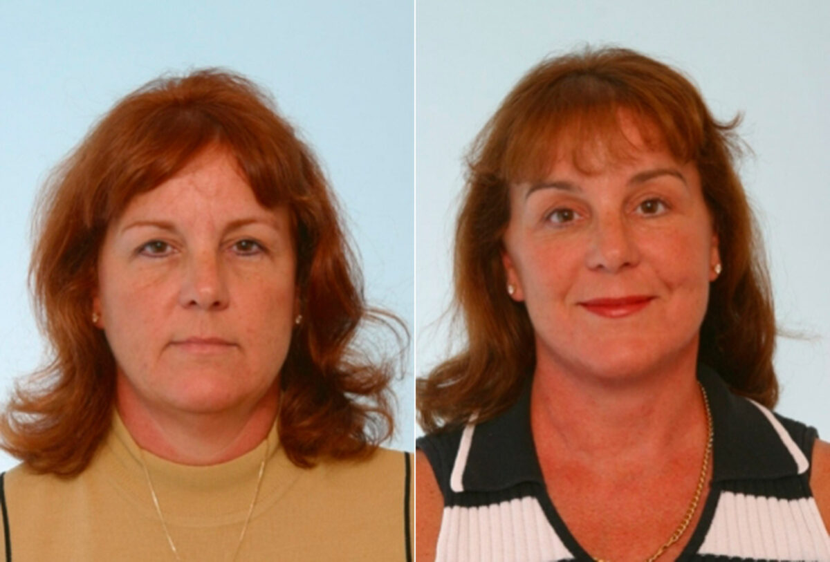 Patient 26483, Blepharoplasty before and after photos Blepharoplasty before and after photos in Houston, TX, Patient 26483