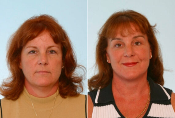 Blepharoplasty before and after photos in Houston, TX