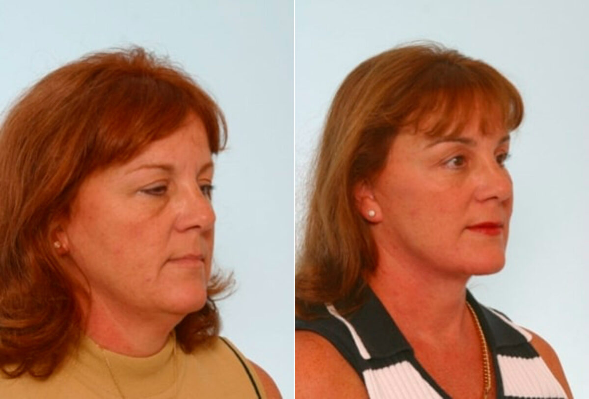 Blepharoplasty before and after photos in Houston, TX, Patient 26483