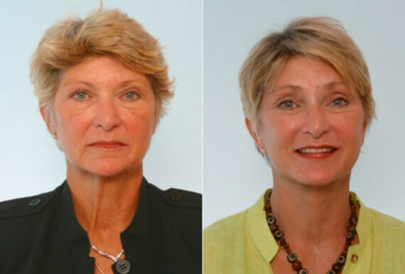Blepharoplasty before and after photos in Houston, TX