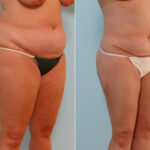 Abdominoplasty before and after photos in Houston, TX, Patient 24428