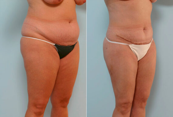 Abdominoplasty before and after photos in Houston, TX, Patient 24428