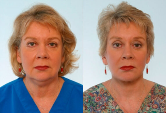 Blepharoplasty before and after photos in Houston, TX, Patient 26497