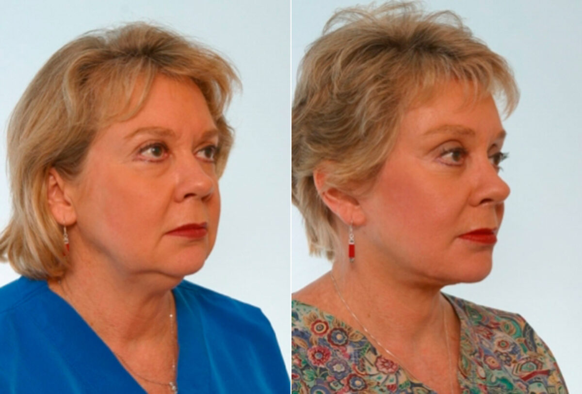 Blepharoplasty before and after photos in Houston, TX, Patient 26497