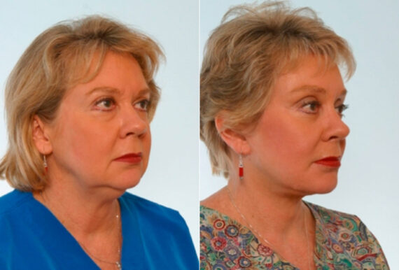 Blepharoplasty before and after photos in Houston, TX, Patient 26497