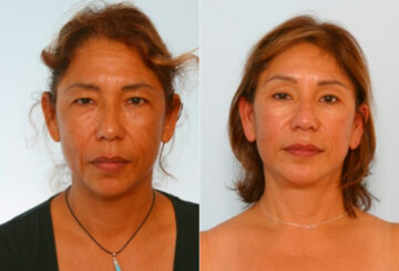 Blepharoplasty before and after photos in Houston, TX, Patient 26504