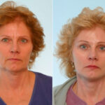 Blepharoplasty before and after photos in Houston, TX, Patient 26507