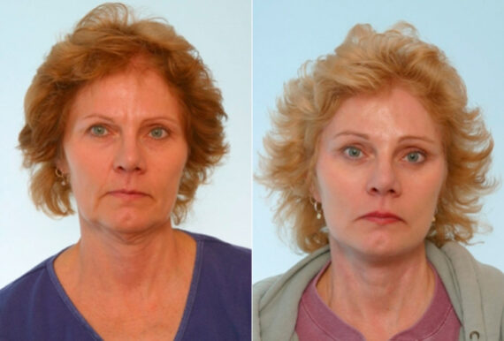 Blepharoplasty before and after photos in Houston, TX, Patient 26507