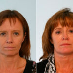 Blepharoplasty before and after photos in Houston, TX, Patient 26517