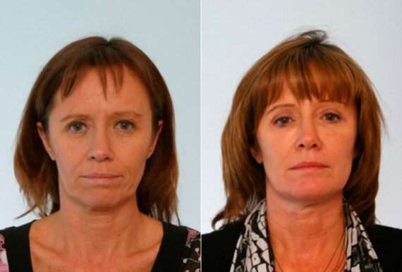 Blepharoplasty before and after photos in Houston, TX, Patient 26517