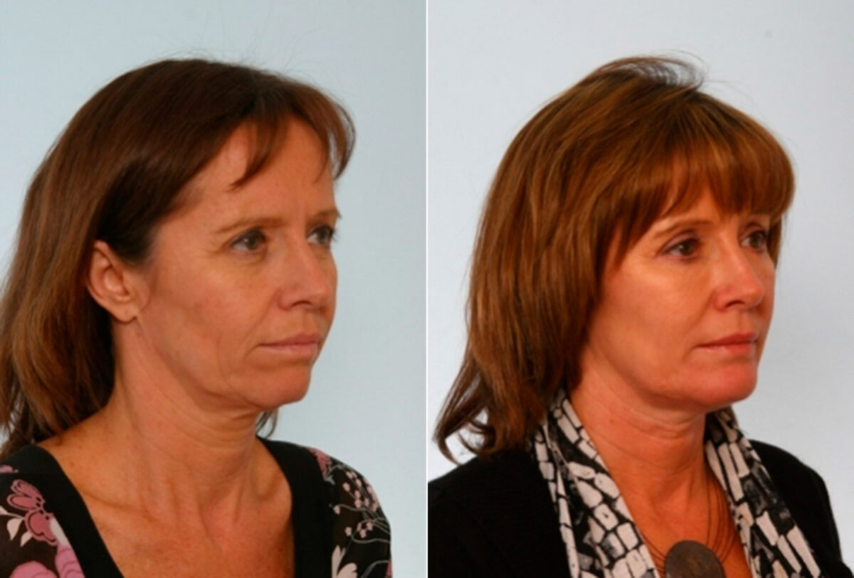 Blepharoplasty before and after photos in Houston, TX, Patient 26517