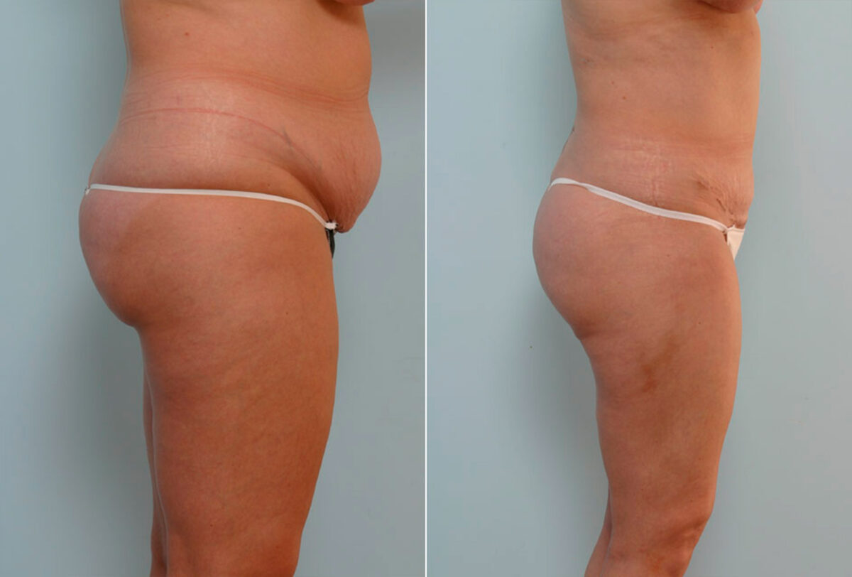 Abdominoplasty before and after photos in Houston, TX, Patient 24428