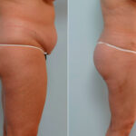 Abdominoplasty before and after photos in Houston, TX, Patient 24428