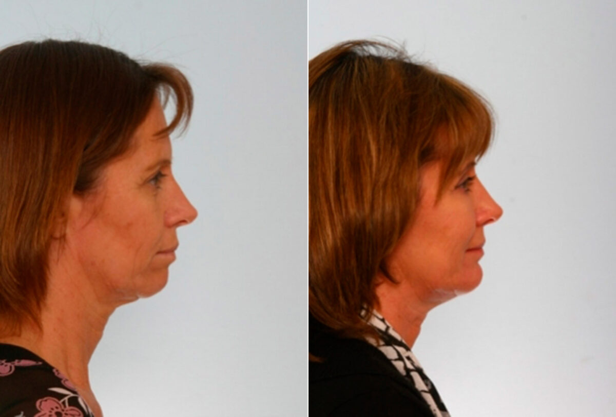 Blepharoplasty before and after photos in Houston, TX, Patient 26517