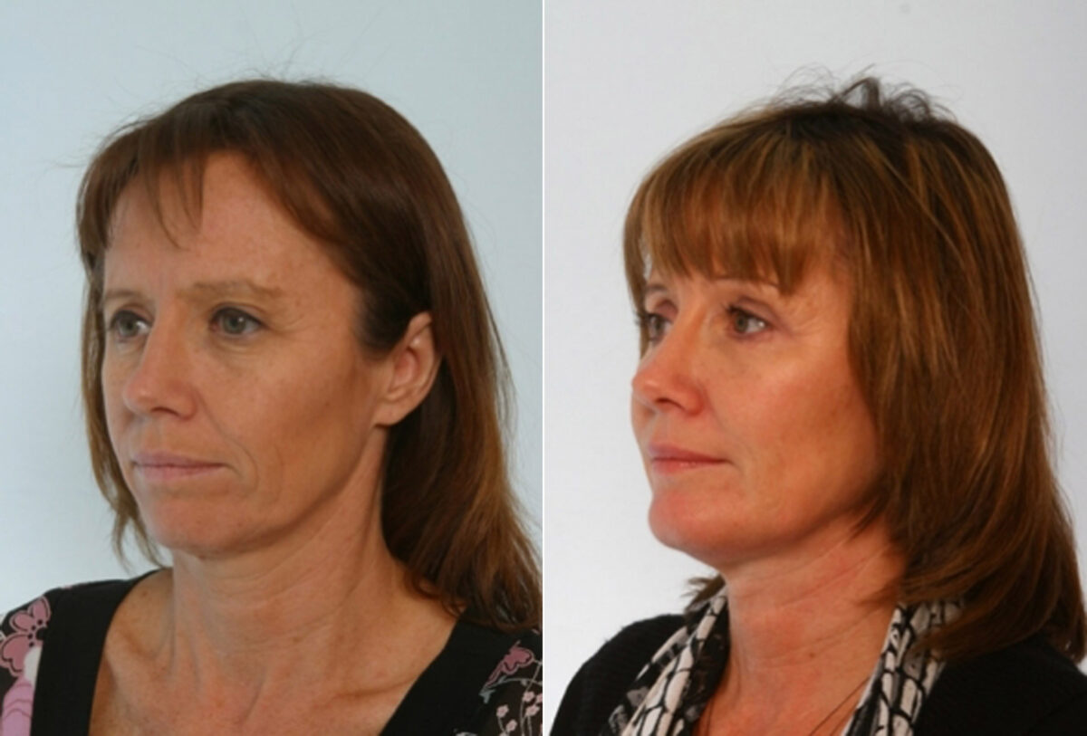 Blepharoplasty before and after photos in Houston, TX, Patient 26517