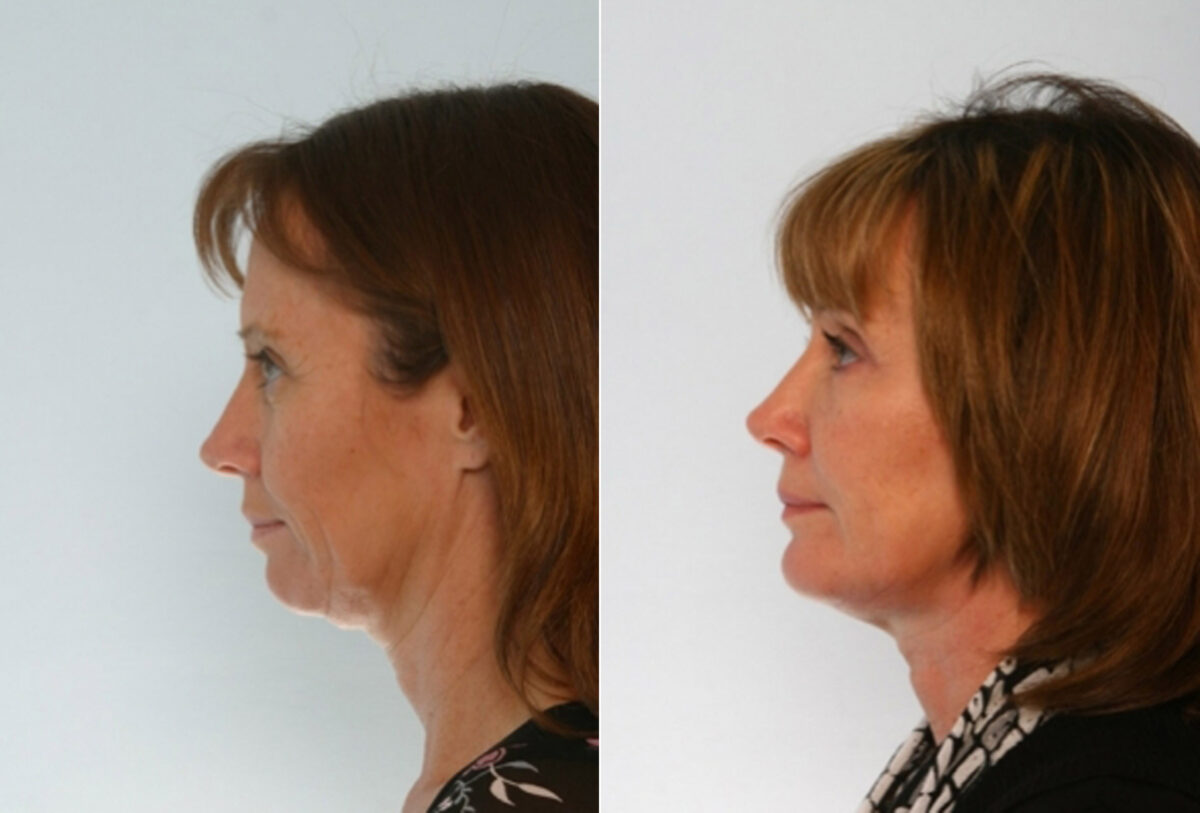 Blepharoplasty before and after photos in Houston, TX, Patient 26517
