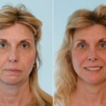 Blepharoplasty before and after photos in Houston, TX, Patient 26528