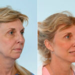 Blepharoplasty before and after photos in Houston, TX, Patient 26528