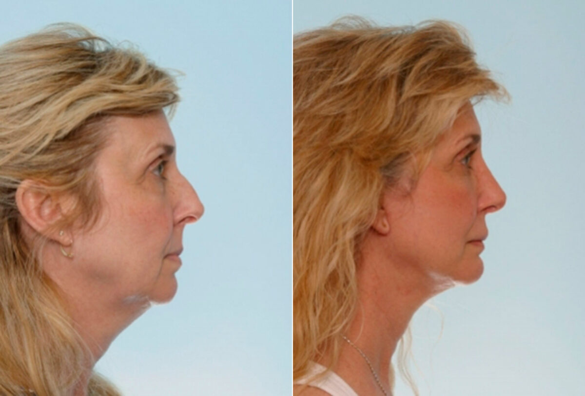 Blepharoplasty before and after photos in Houston, TX, Patient 26528