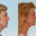 Blepharoplasty before and after photos in Houston, TX, Patient 26528