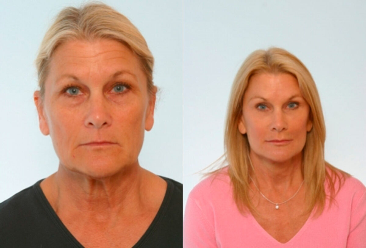 Blepharoplasty before and after photos in Houston, TX, Patient 26535